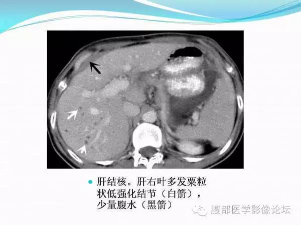 【PPT】腹部结核