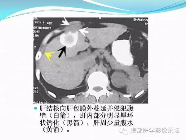 【PPT】腹部结核