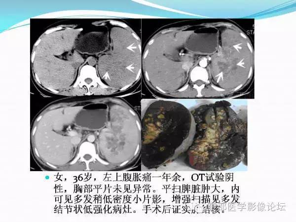 【PPT】腹部结核