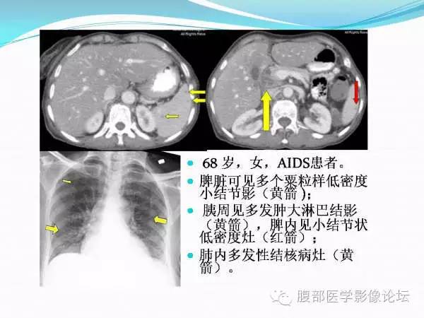 【PPT】腹部结核