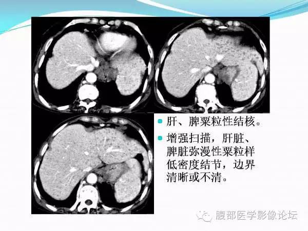 【PPT】腹部结核