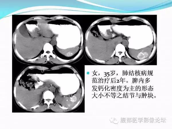 【PPT】腹部结核