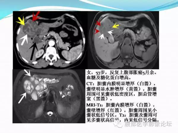 【PPT】腹部结核