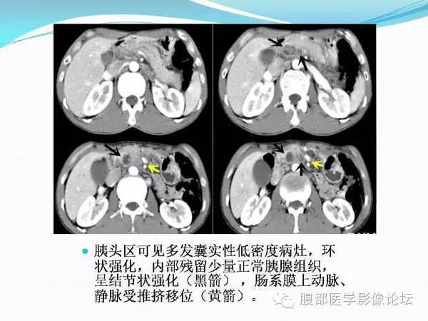 【PPT】腹部结核