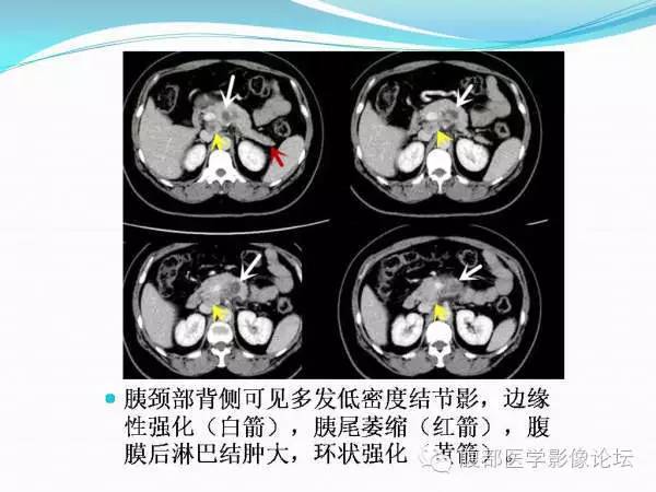 【PPT】腹部结核