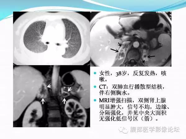 【PPT】腹部结核