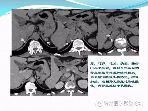 【PPT】腹部结核
