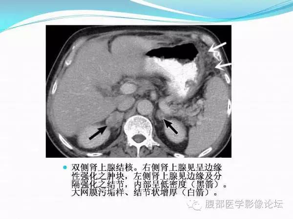 【PPT】腹部结核