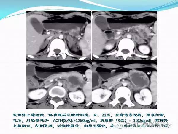 【PPT】腹部结核