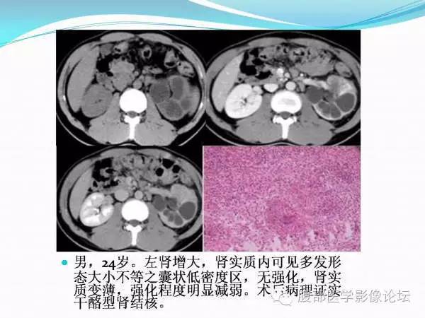 【PPT】腹部结核