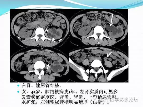 【PPT】腹部结核