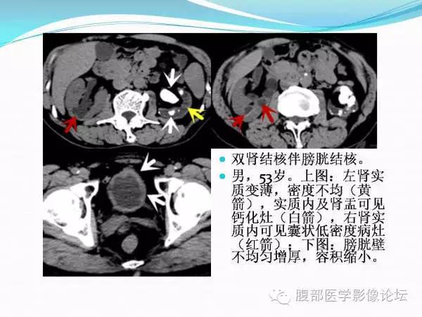 【PPT】腹部结核