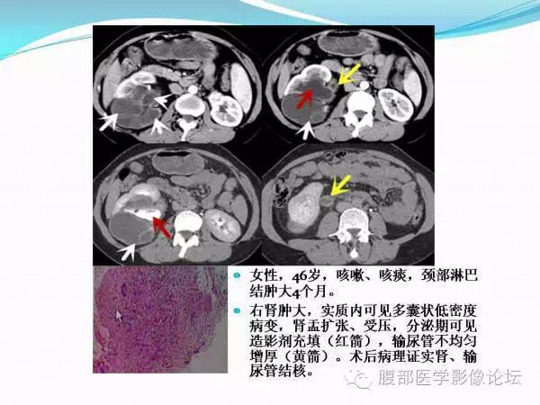 【PPT】腹部结核
