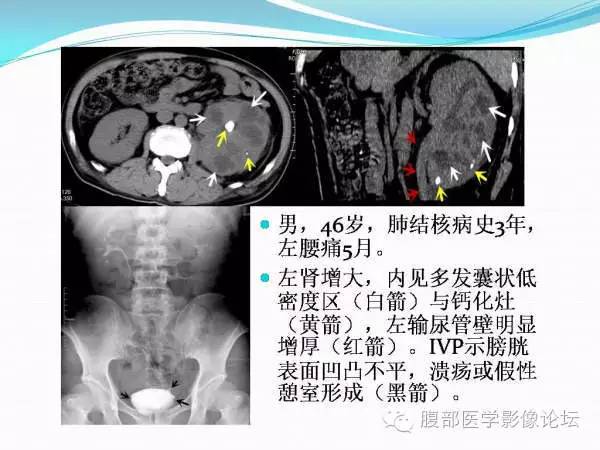 【PPT】腹部结核