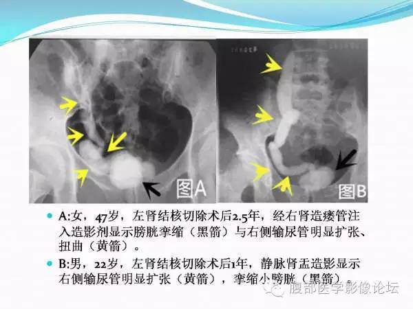 【PPT】腹部结核