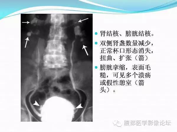 【PPT】腹部结核