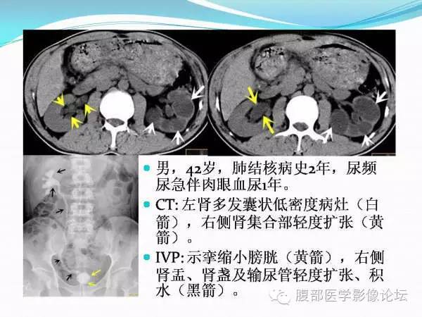 【PPT】腹部结核