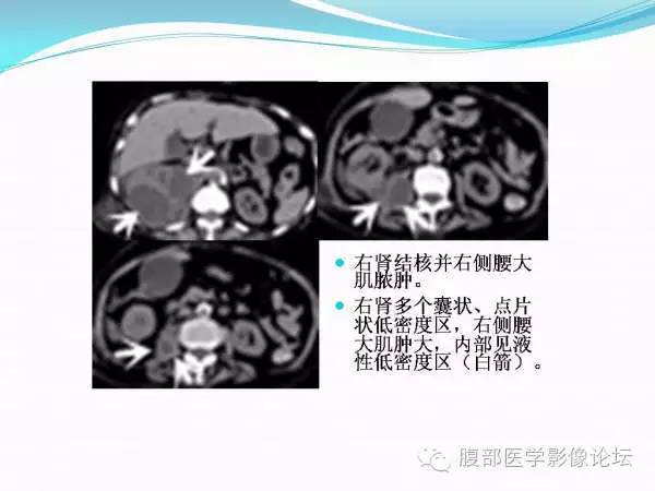 【PPT】腹部结核