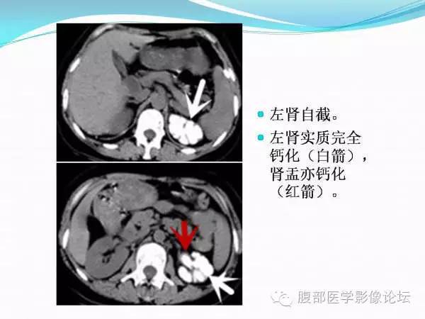 【PPT】腹部结核
