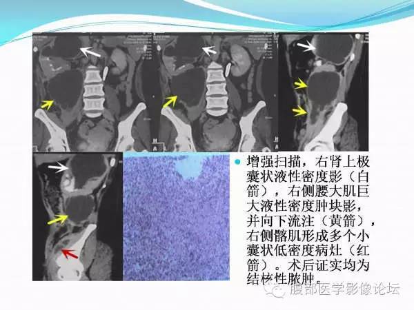【PPT】腹部结核