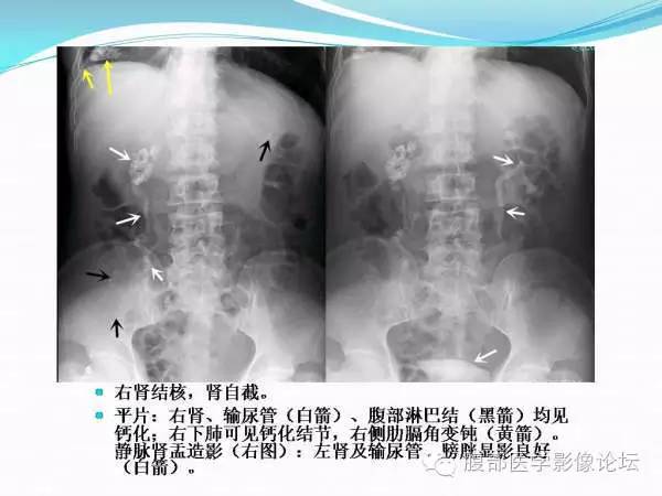 【PPT】腹部结核
