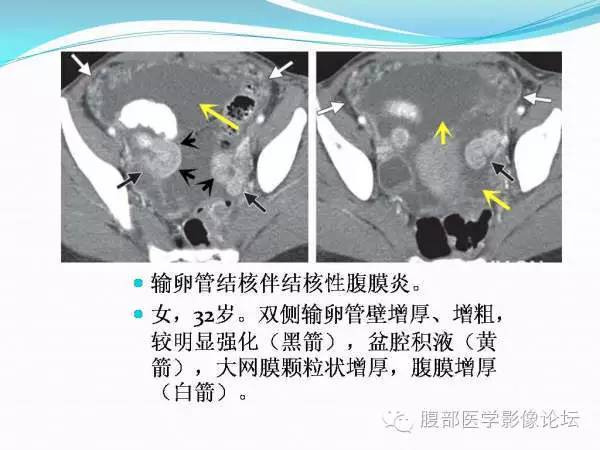 【PPT】腹部结核