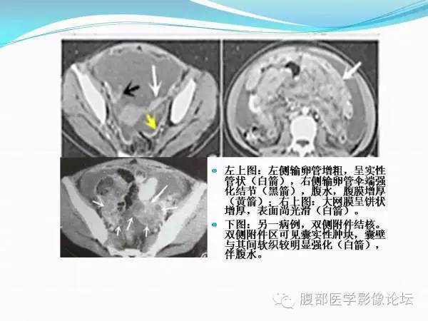 【PPT】腹部结核