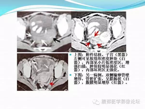 【PPT】腹部结核