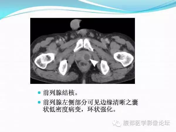 【PPT】腹部结核