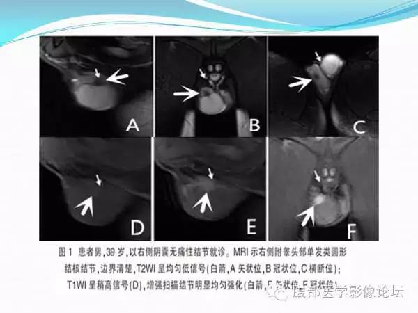 【PPT】腹部结核