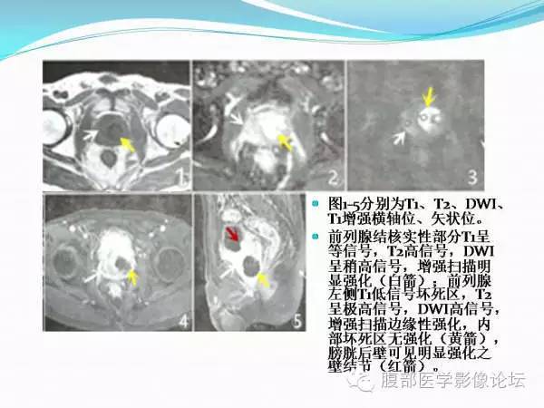 【PPT】腹部结核