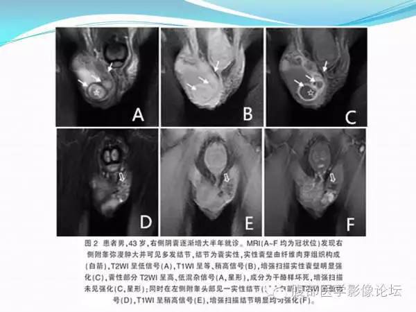 【PPT】腹部结核