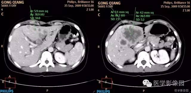 【病例】不典型肝细胞肝癌1例CT影像表现 【病例】不典型肝细胞肝癌1例CT影像表现