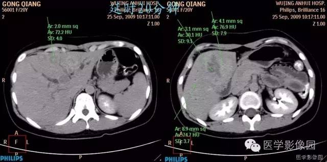 【病例】不典型肝细胞肝癌1例CT影像表现 【病例】不典型肝细胞肝癌1例CT影像表现