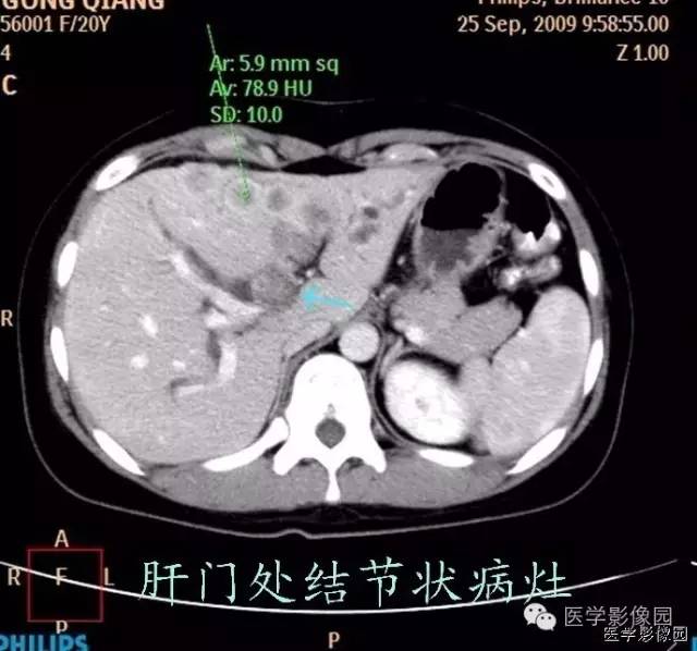 【病例】不典型肝细胞肝癌1例CT影像表现 【病例】不典型肝细胞肝癌1例CT影像表现