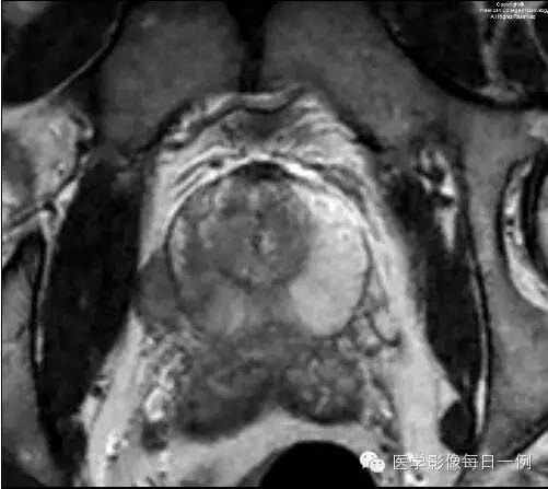 【病例】前列腺癌1例MR影像表现