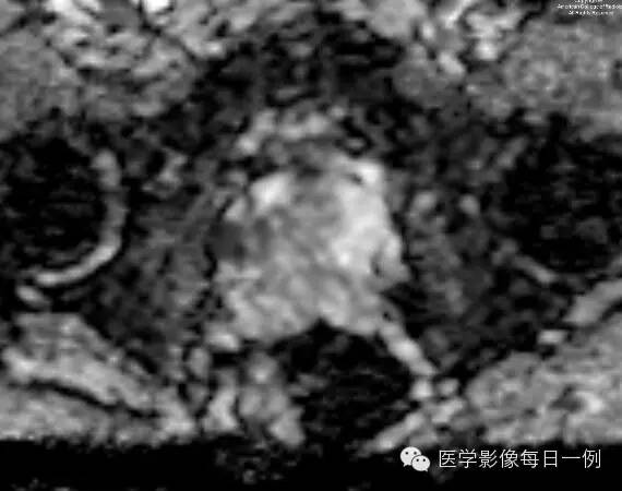 【病例】前列腺癌1例MR影像表现