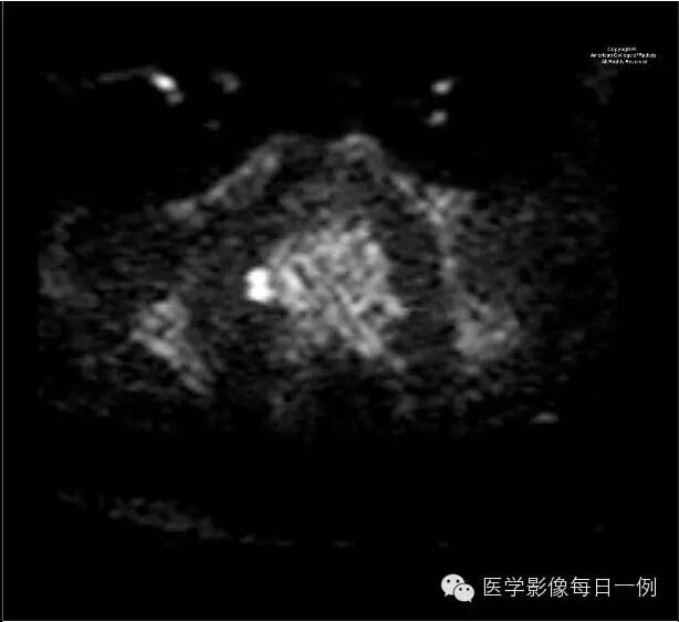 【病例】前列腺癌1例MR影像表现