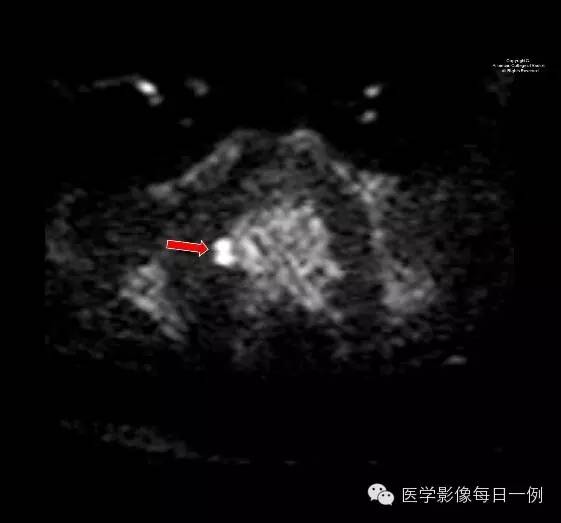 【病例】前列腺癌1例MR影像表现