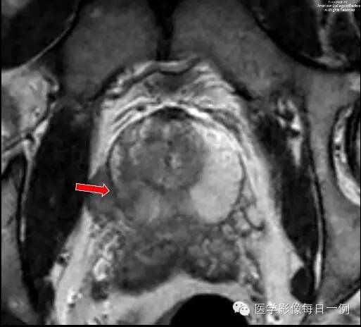 【病例】前列腺癌1例MR影像表现