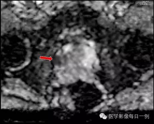 【病例】前列腺癌1例MR影像表现