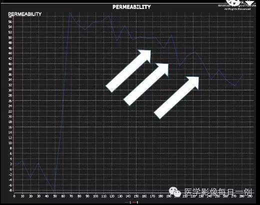 【病例】前列腺癌1例MR影像表现