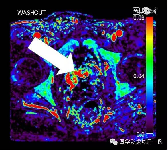 【病例】前列腺癌1例MR影像表现