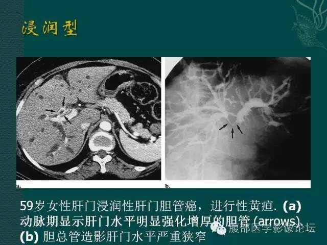 【PPT】胆管癌的CT诊断
