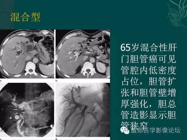 【PPT】胆管癌的CT诊断