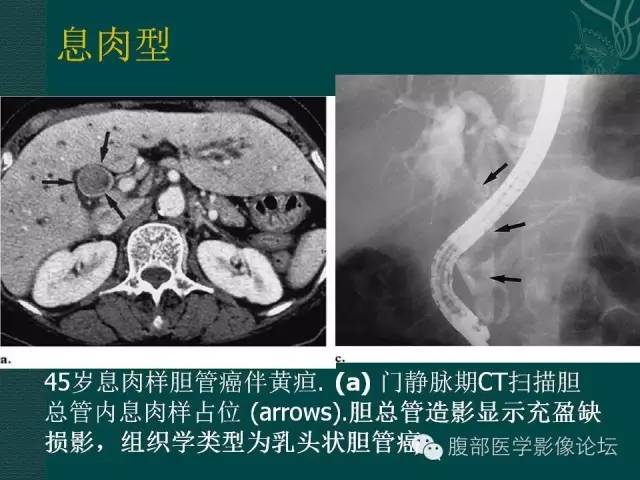 【PPT】胆管癌的CT诊断