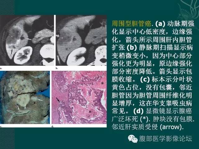 【PPT】胆管癌的CT诊断