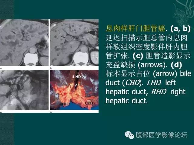 【PPT】胆管癌的CT诊断