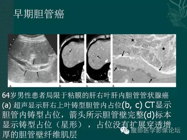 【PPT】胆管癌的CT诊断