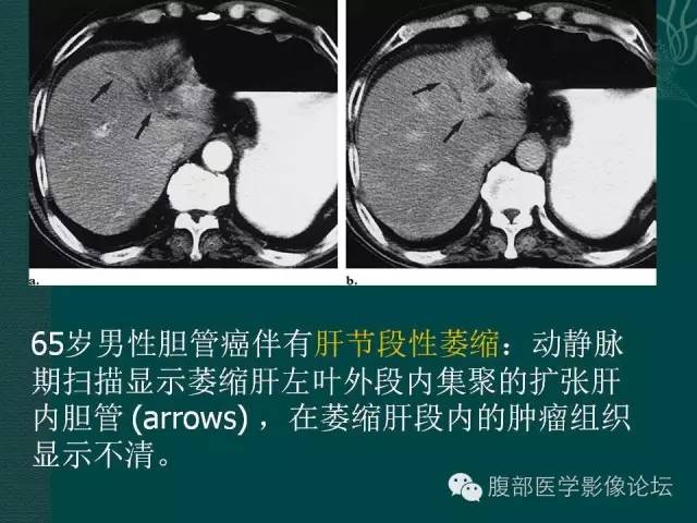 【PPT】胆管癌的CT诊断